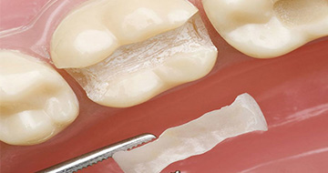 Indirect Restorations