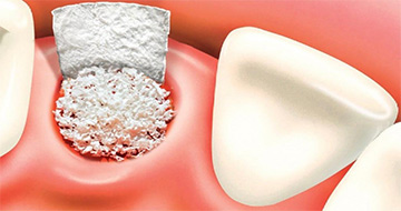 Bone Graft