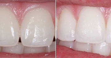 Dental Bounding