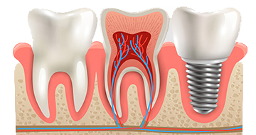 Dental Implant