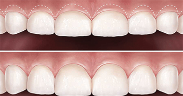 Gum Reduction Surgery
