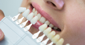 Porcelain Veneers​. Cosmetic dentist in Vancouver
